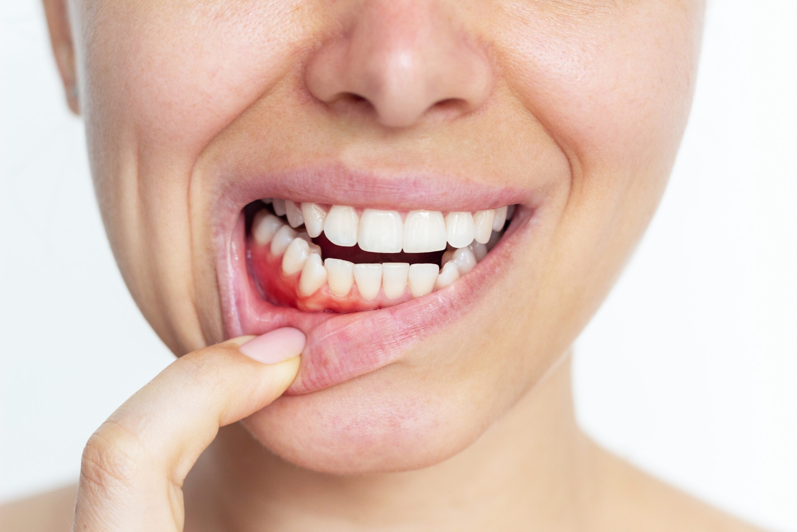 What is Gingivitis? Understanding, Prevention, and Treatment of Gum Disease